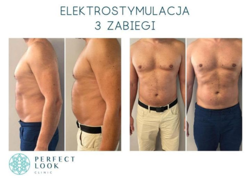 elektrostymulacja