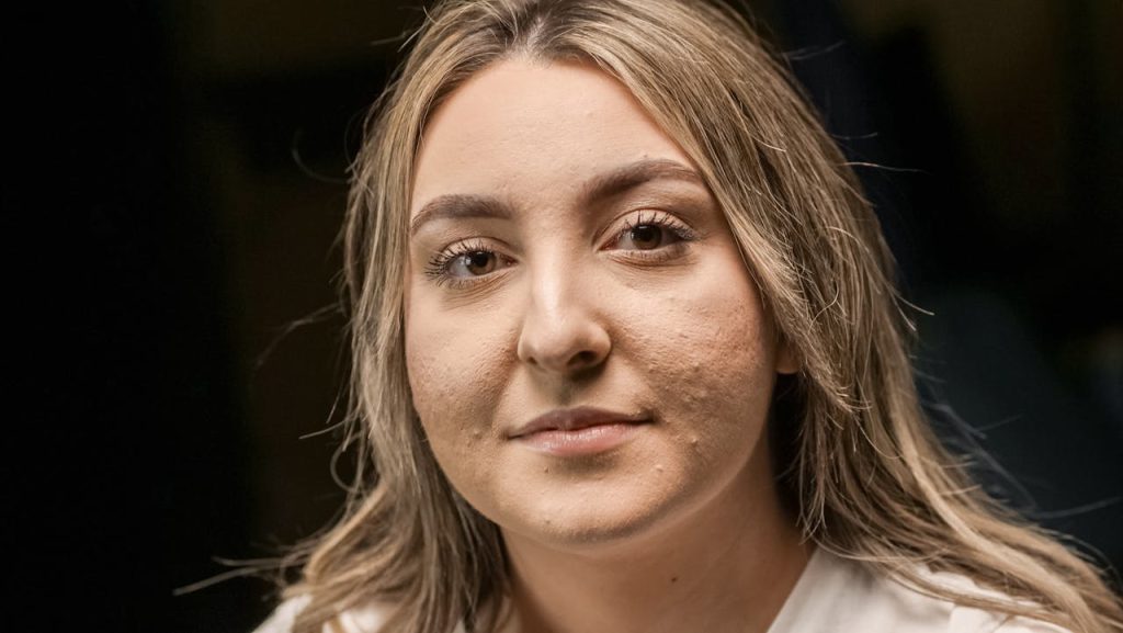 zaburzenia androgenowe, Peeling kawitacyjny Warszawa